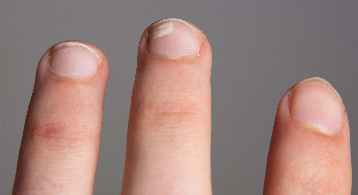 Manchas blancas en las uñas