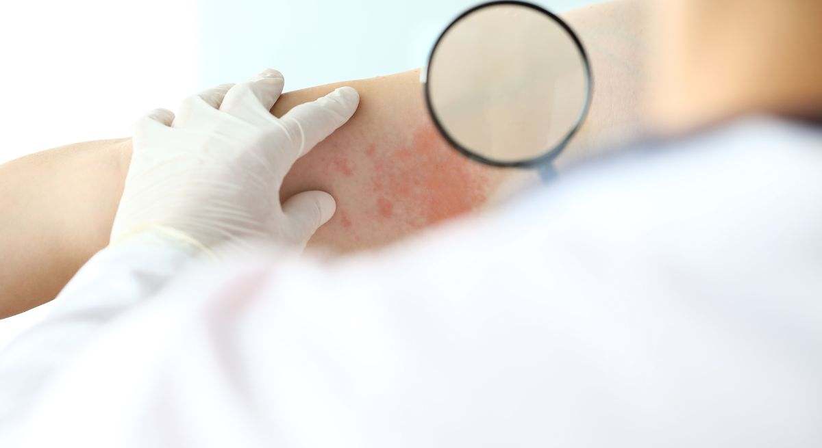 El aviso de una dermatóloga en España