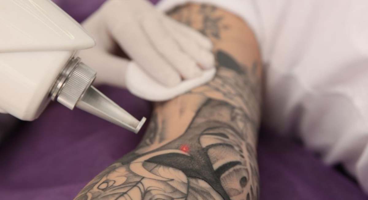 Eliminacion-tatuajes-1200.jpg