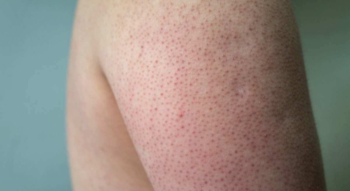 El truco de los dermatólogos para deshacerse de la queratosis pilaris.