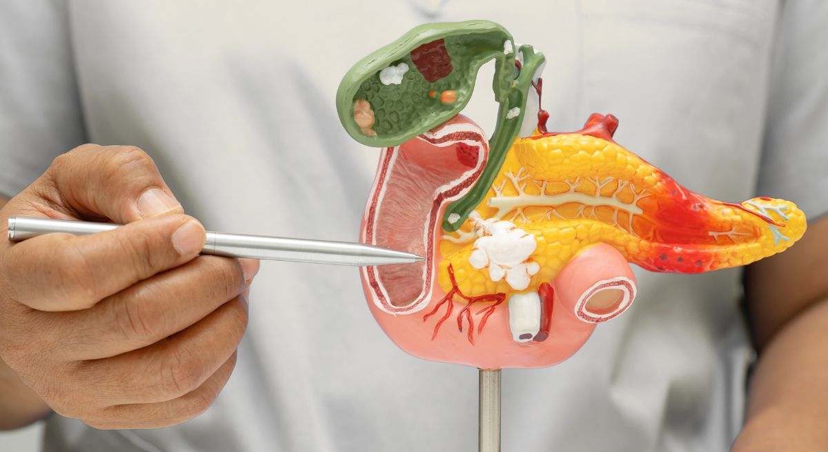 Cáncer de páncreas
