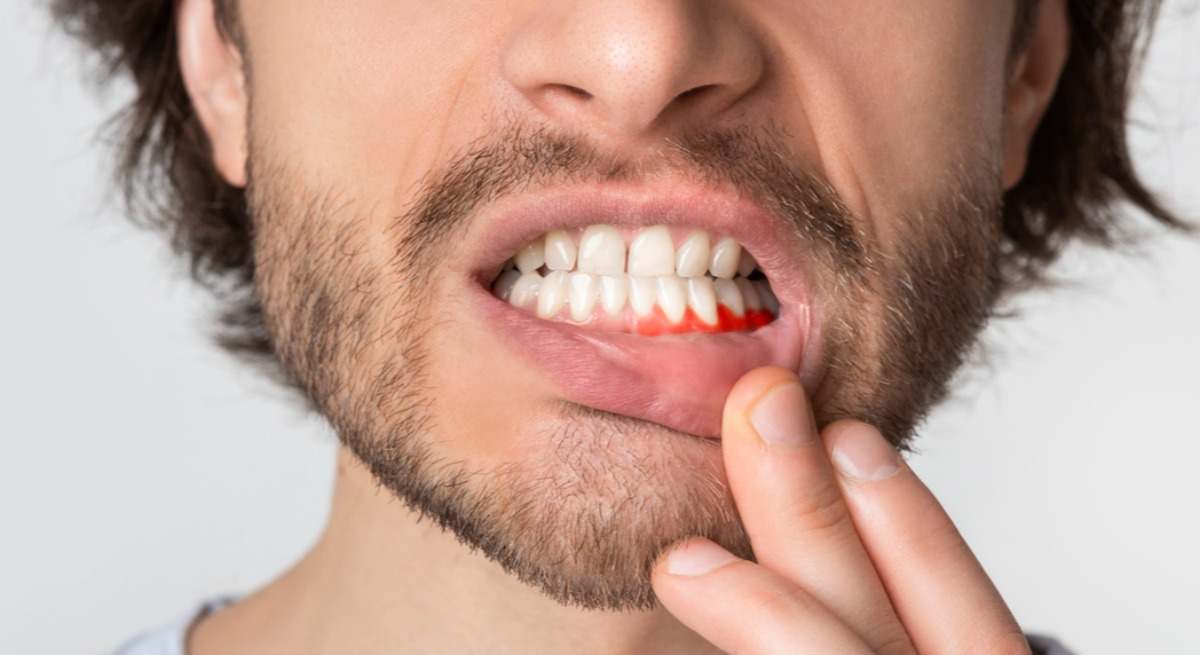 Encías inflamadas