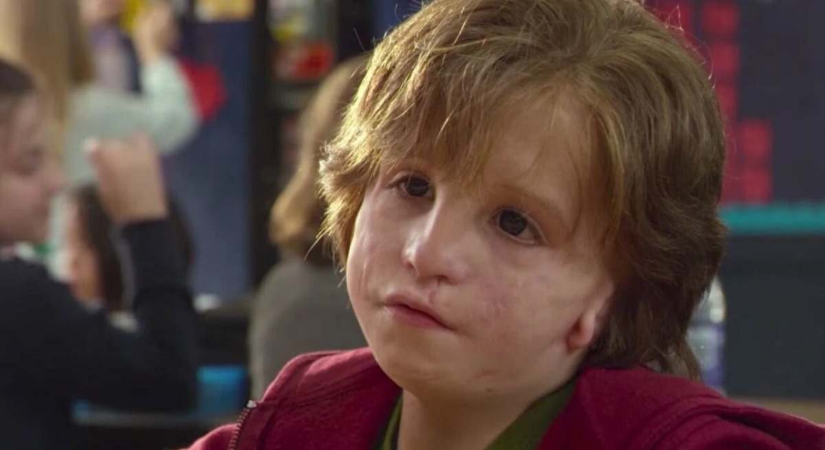 ¿Que es el síndrome de Treacher Collins? Descubre los síntomas de esta enfermedad rara en este post.