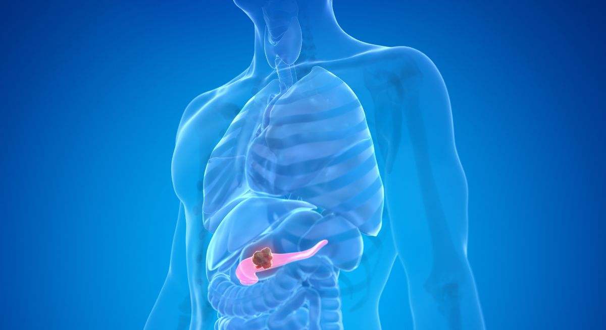 El cáncer de páncreas es un tipo de cáncer que se forma en los tejidos del páncreas