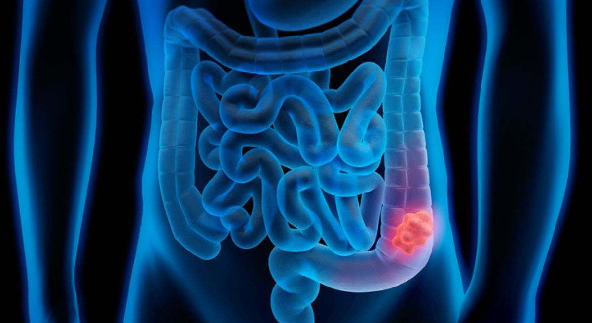 Estos son los cinco grandes avances en el tratamiento del cáncer anal y rectal con radioterapia