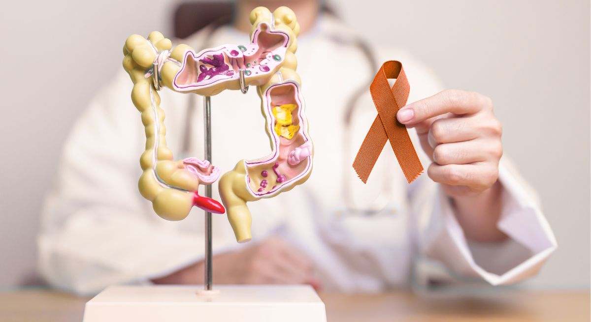 Cáncer de colon