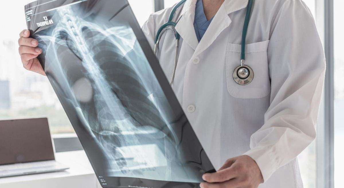 Hay dos tipos principales: cáncer de pulmón de células pequeñas y cáncer de pulmón de células no pequeñas.