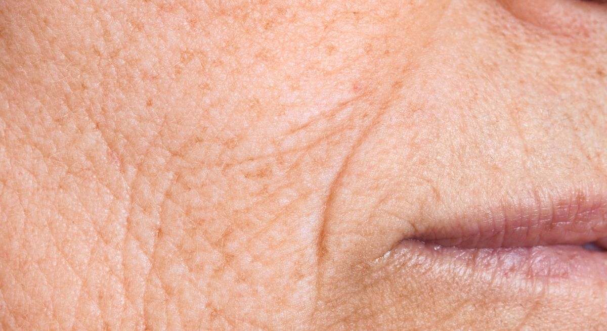 Las arrugas son líneas y pliegues que se forman en la piel