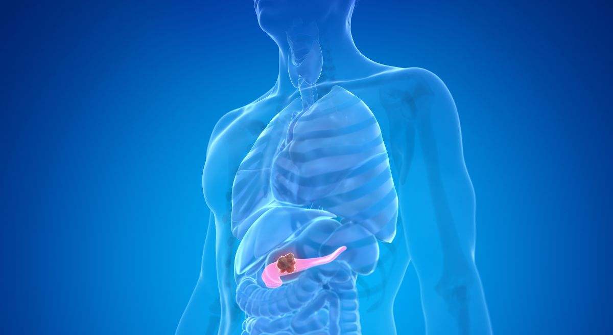 El cáncer de páncreas se inicia en el páncreas, un órgano que está ubicado en la parte profunda del abdomen detrás del estómago
