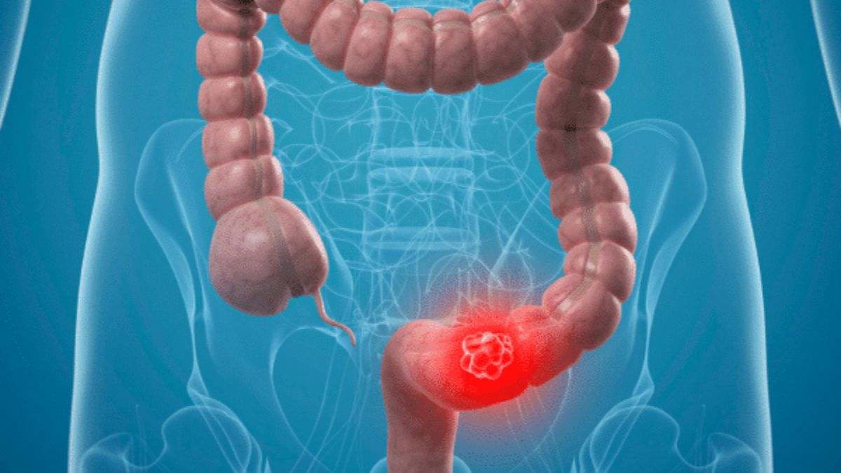 El cáncer colorrectal es un cáncer que se desarrolla en los tejidos del colon o del recto