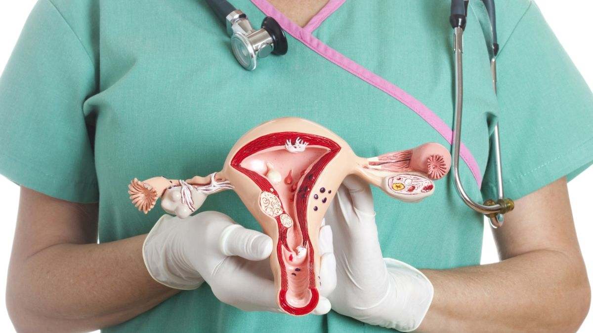 El cáncer de cuello uterino es cáncer que se origina en las células del cuello del útero