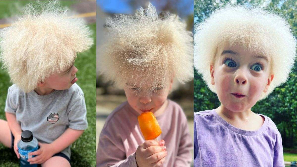 Qué es el síndrome del pelo 'impeinable': afección dermatológica que deja al cabello seco y rizado