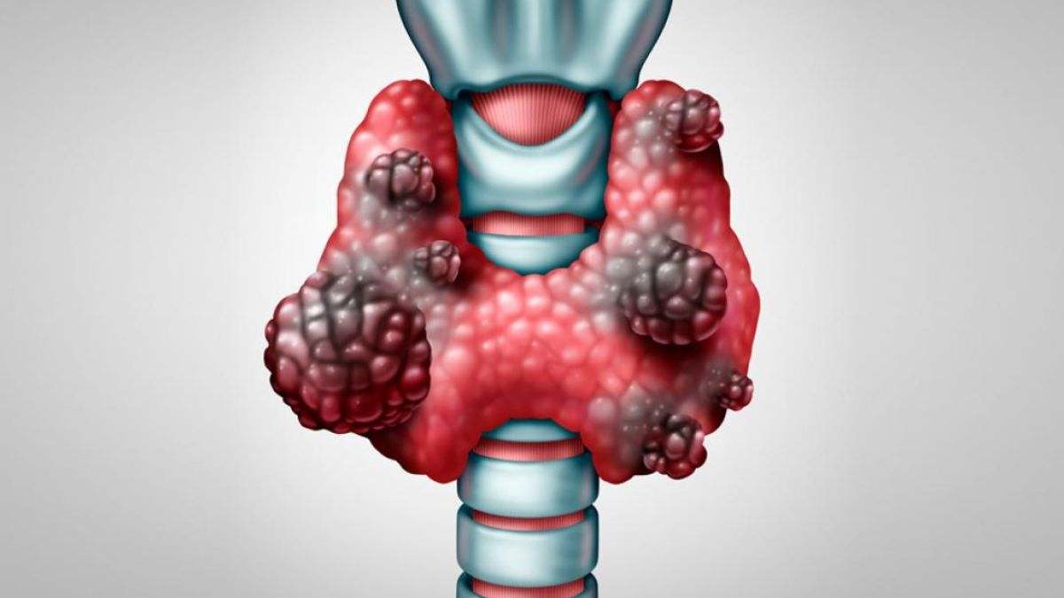 El cáncer de tiroides es una proliferación de células que comienza en la glándula tiroidea