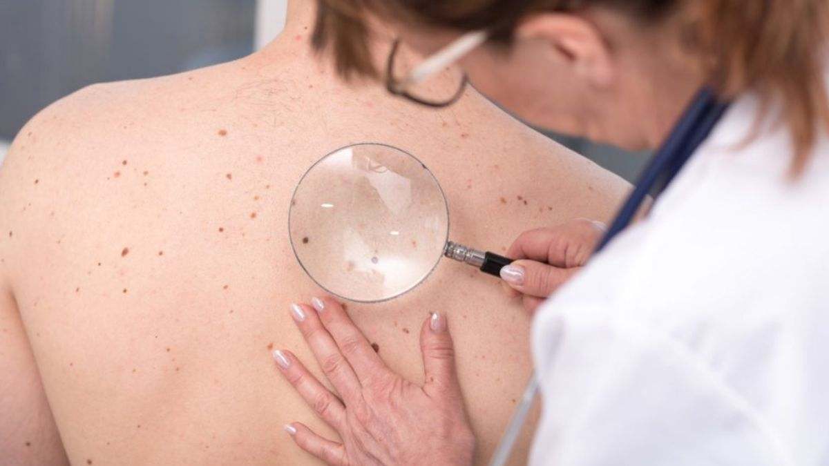 El cáncer de piel es uno de los tumores de mayor incidencia en el ser humano