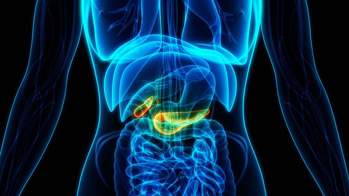 El cáncer de páncreas se desarrolla cuando las células del páncreas crecen de manera descontrolada, formando un tumor