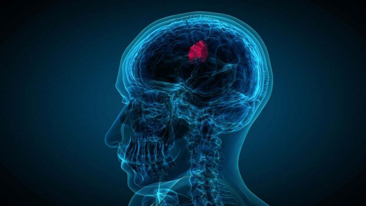 El glioblastoma es un cáncer agresivo que se encuentra en el cerebro o la médula espinal