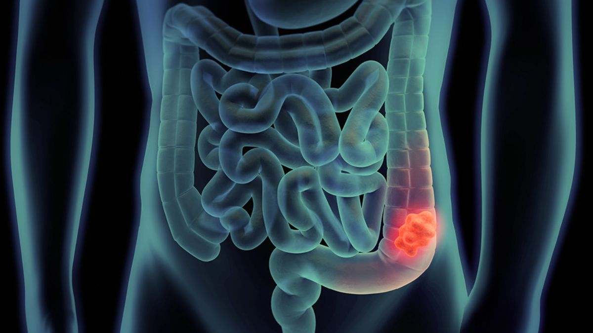 El cáncer colorrectal es el que se origina en el colon o el recto