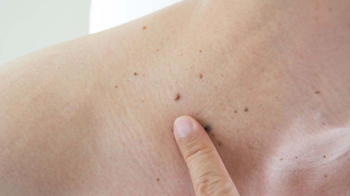 Las verrugas son crecimientos de la piel causados por un virus
