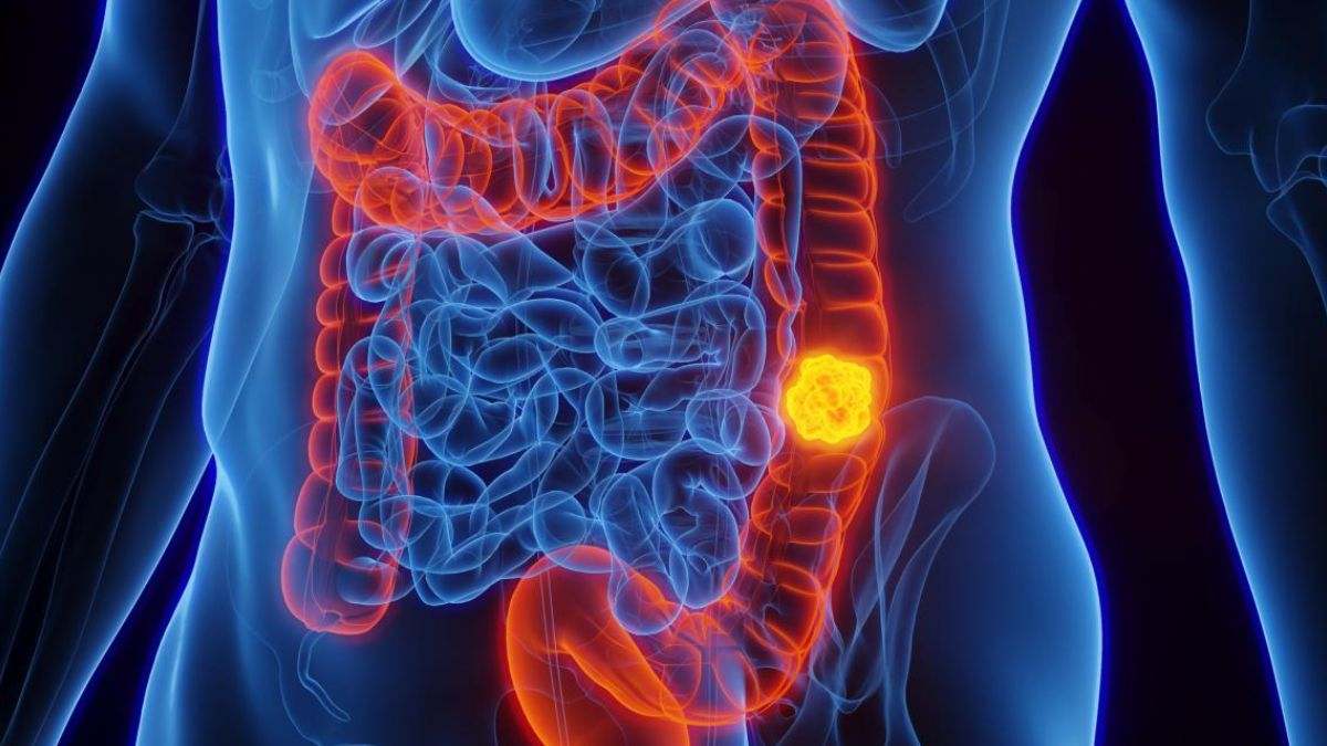 El cáncer de colon es una enfermedad por la que se forman células malignas (cancerosas) en los tejidos del colon
