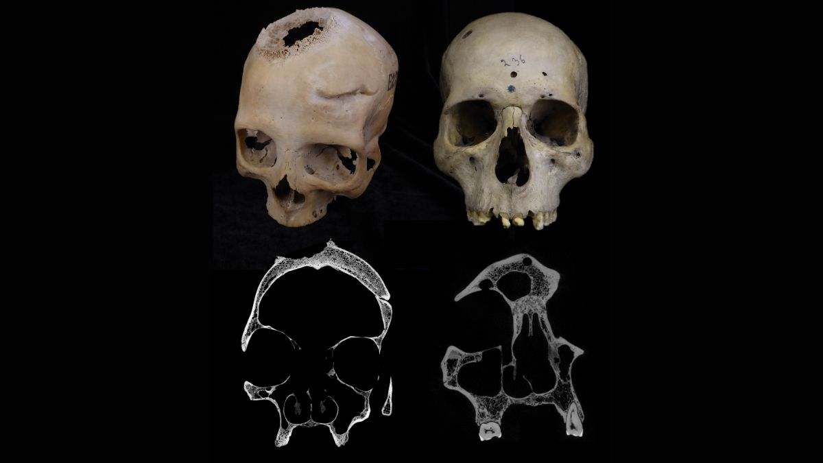 Un revelador estudio español muestra la primera cirugía para el cáncer de hace 4.000 años en Egipto