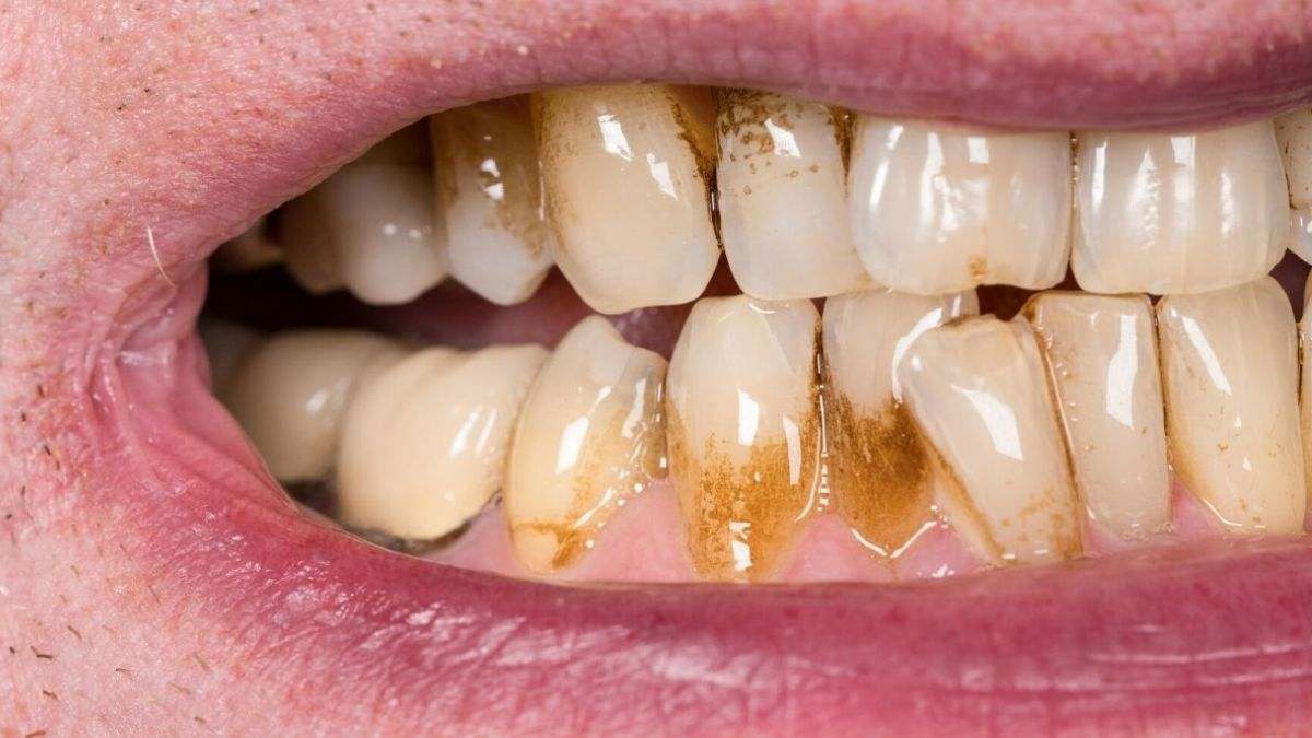 El sarro dental es el resultado de la calcificación de la placa bacteriana y tiene consecuencias en la boca