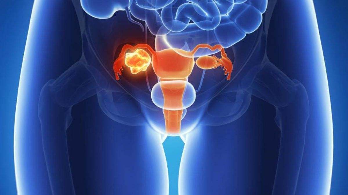 El cáncer de ovario es un tumor canceroso que se forma en los tejidos de un ovario