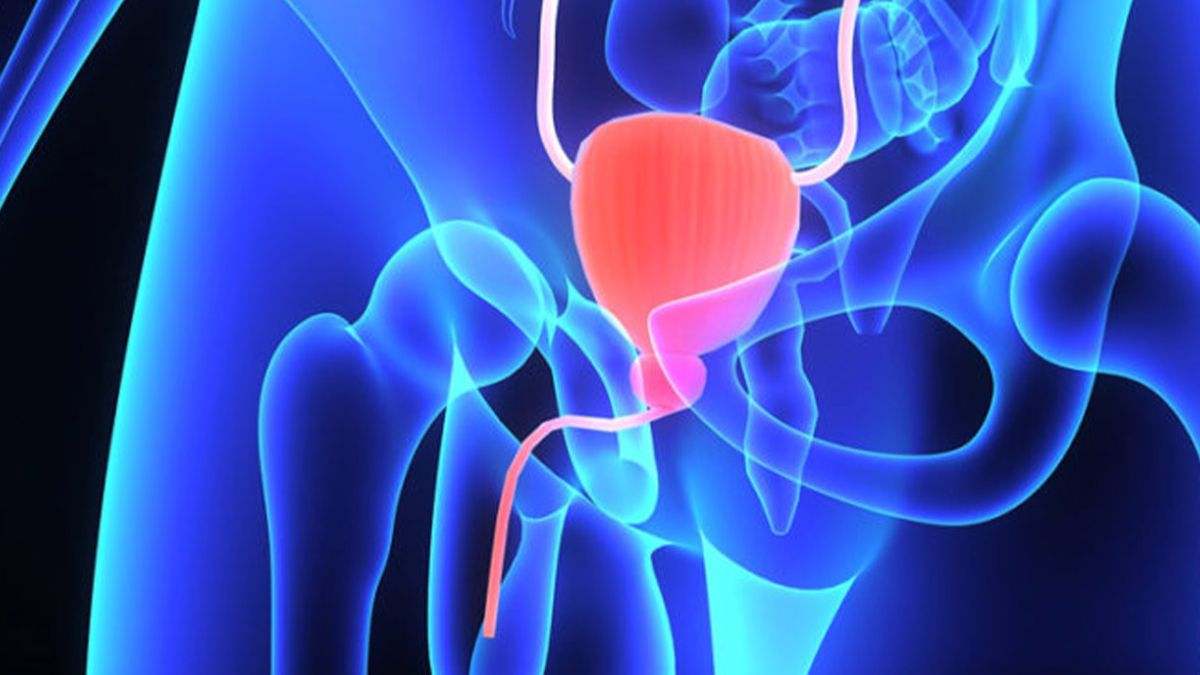 El cáncer de próstata es un tipo de cáncer que se forma en los tejidos de la próstata