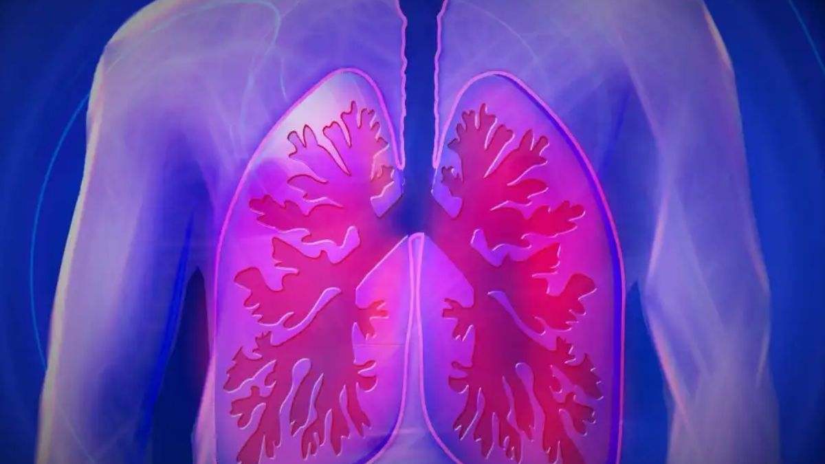 El cáncer de pulmón puede estrechar la vía respiratoria y provocar sibilancias