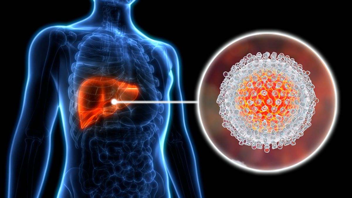 La hepatitis C es una inflamación del hígado