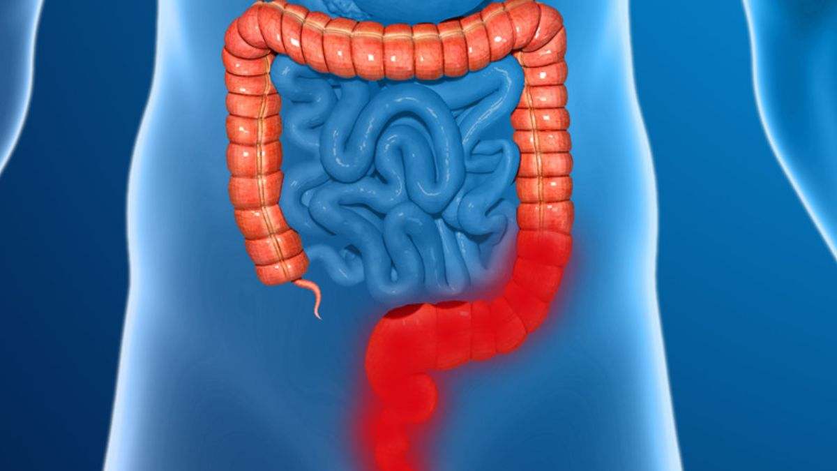 El cáncer colorrectal es un tumor maligno que se origina en el colon o el recto