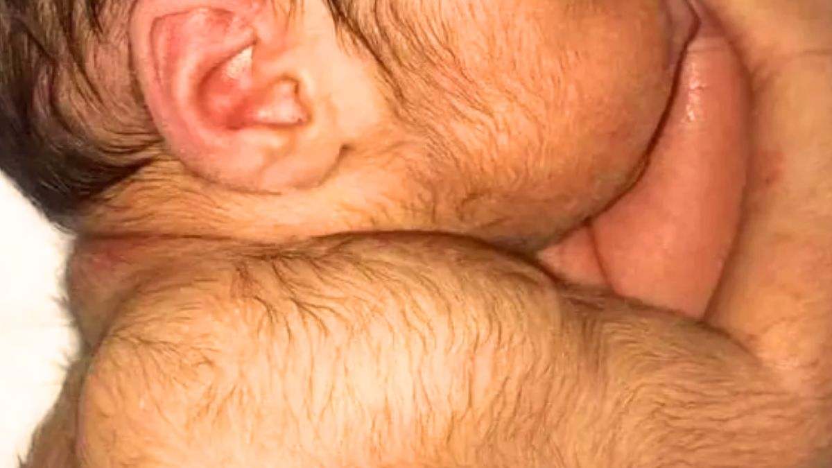 Estos son los riesgos del minoxidil, el fármaco crecepelo que está detrás de los casos de menores con 'síndrome del hombre lobo'