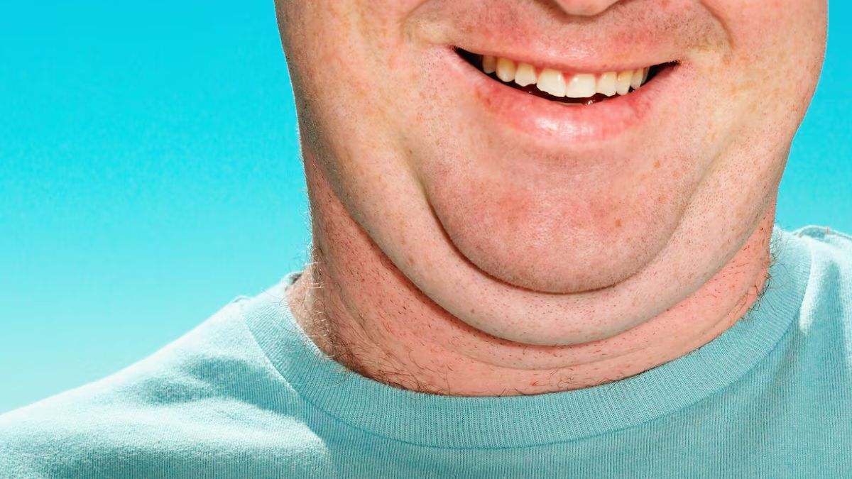 La papada es la acumulación de grasa y piel que se produce en el cuello, debajo de la barbilla