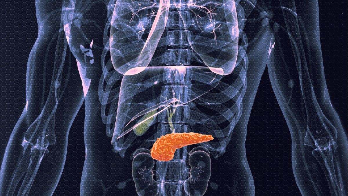 El cáncer de páncreas es un tumor del páncreas