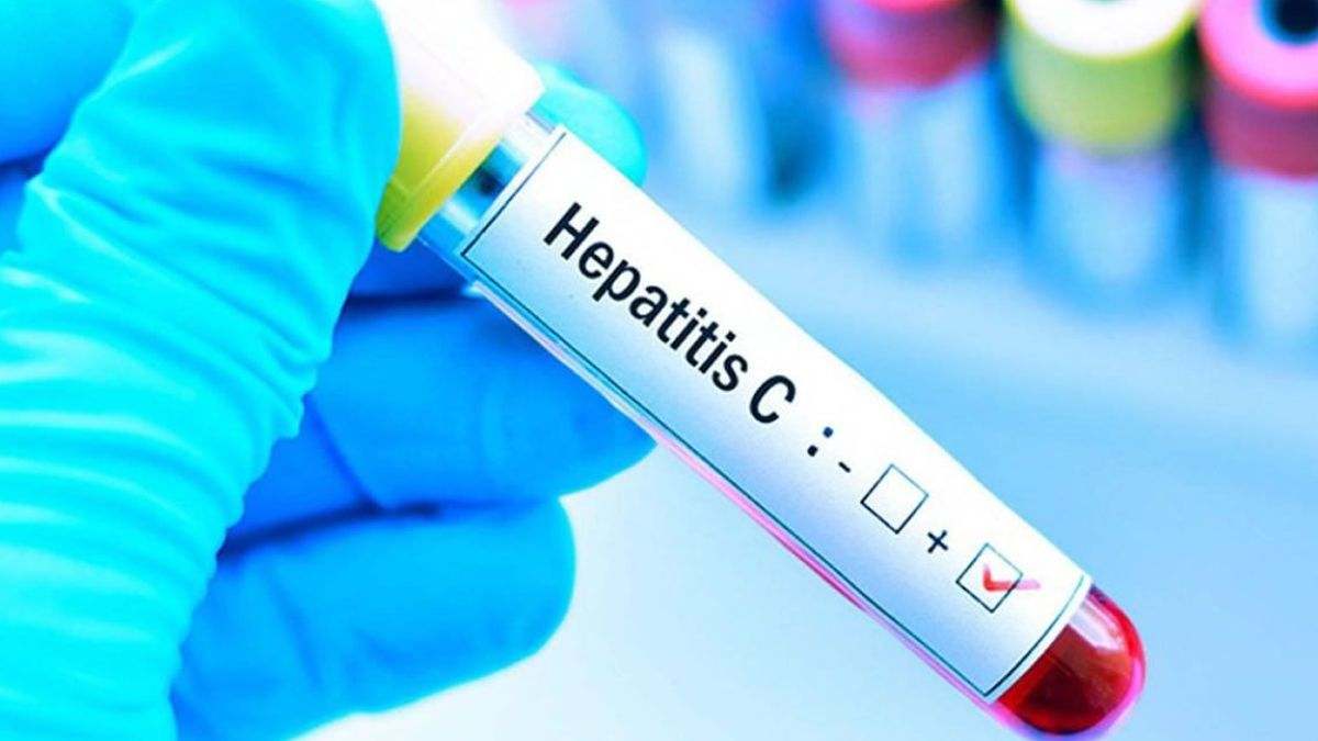 La hepatitis C (VHC) es un virus que causa inflamación del hígado