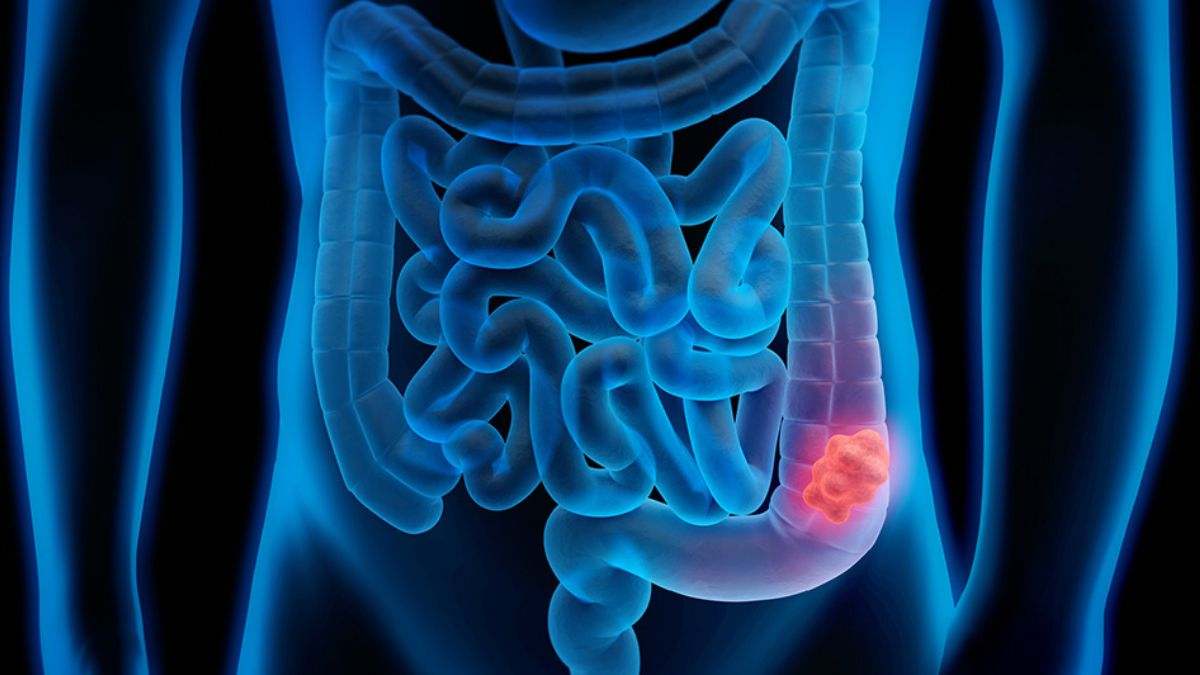 El cáncer de colon a menudo se desarrolla lentamente durante varios años
