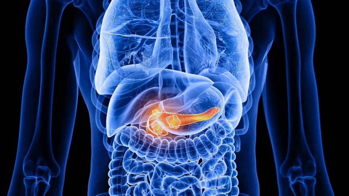 El cáncer pancreático es un tipo de cáncer que se origina en el páncreas