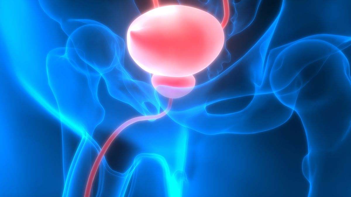 El cáncer de vejiga ocurre en la membrana interna de la vejiga