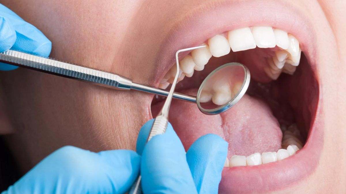 El sarro dental es un depósito duro de color amarillento o marrón que se forma en los dientes