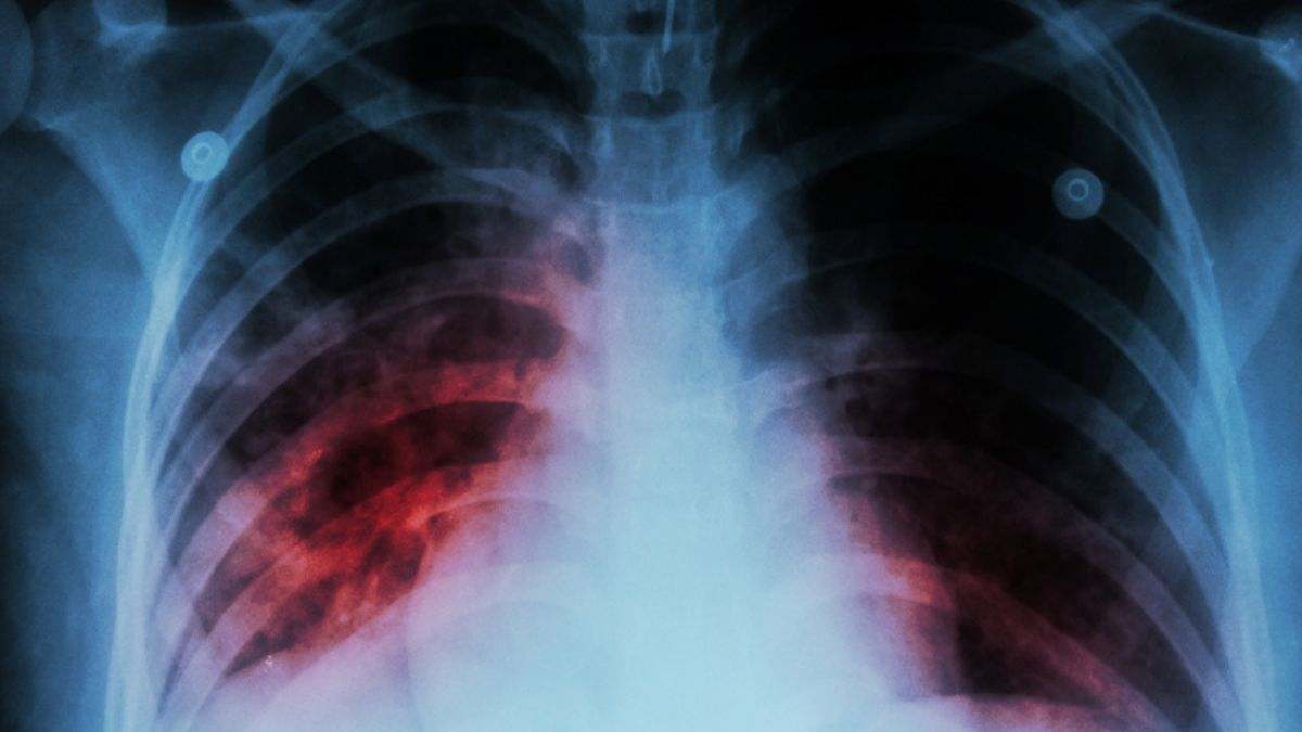 Tuberculosis en España: Epidemiología advierte sobre la tendencia al alza de la enfermedad