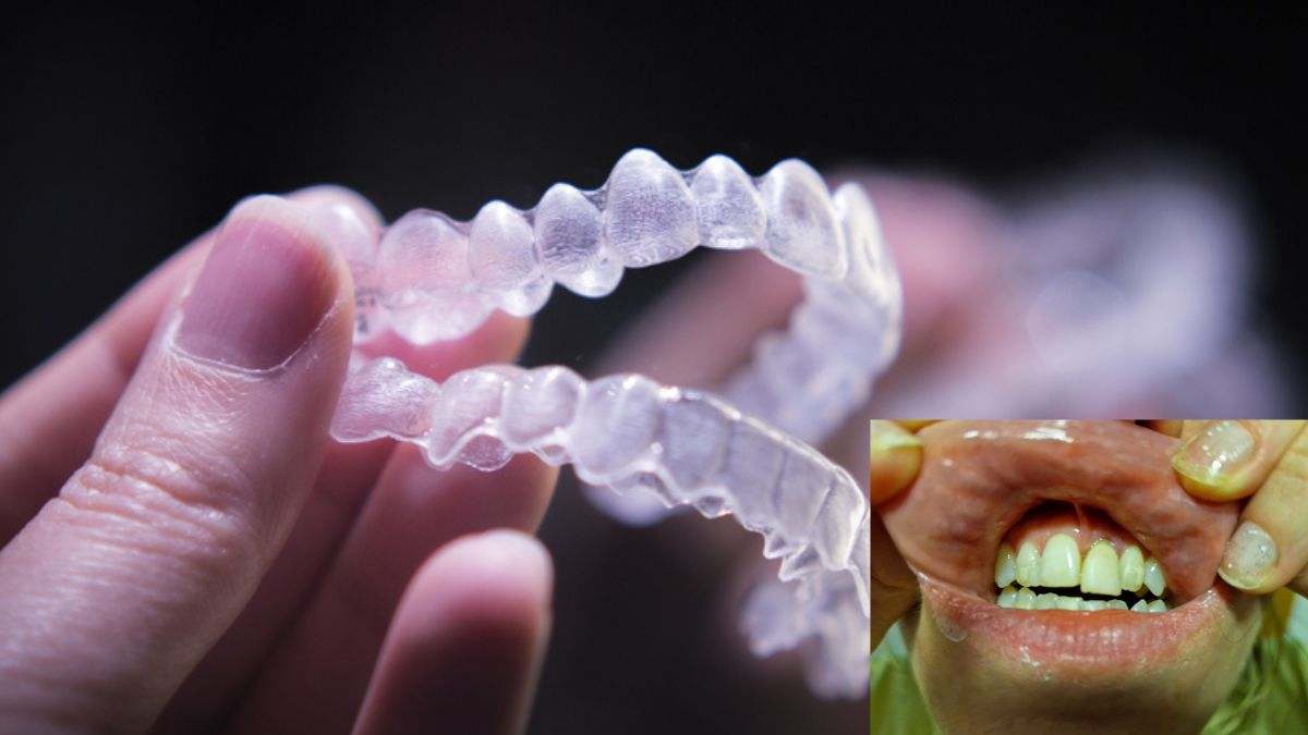 Abogada y víctima de los alineadores dentales invisibles: Los casos más graves de esta estafa no están preparados para salir a la luz