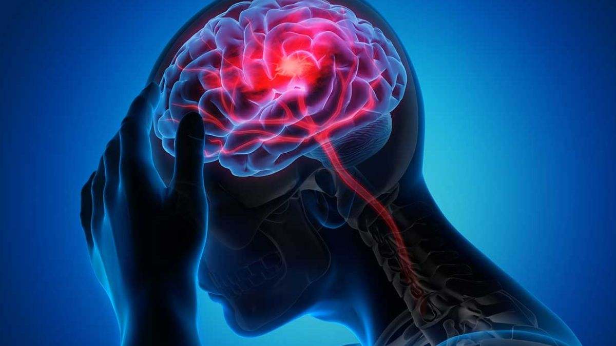 Un derrame cerebral ocurre cuando se interrumpe el flujo sanguíneo al cerebro