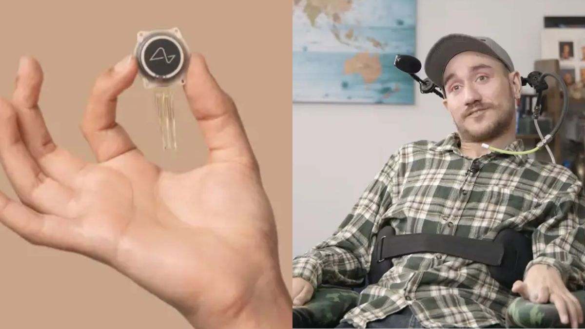 El primer hombre al que Musk implantó un chip en el cerebro sufre problemas tras un fallo