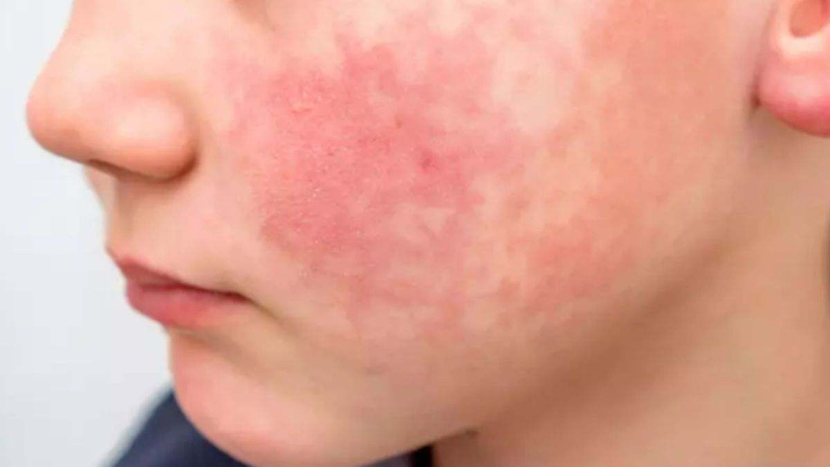 Alerta por repunte del virus de la 'bofetada' en colegios y guarderías: estos son los síntomas de la infección