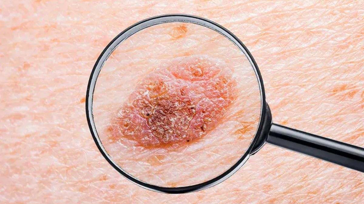 Cáncer de piel