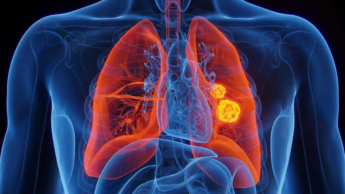 El cáncer de pulmón es un cáncer que se forma en los tejidos del pulmón, generalmente en las células que recubren los conductos de aire.