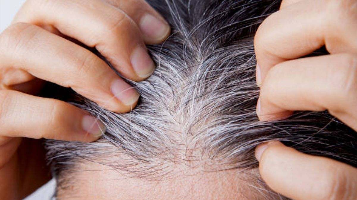 Las canas son pelos que carecen de pigmentación por falta de melanina