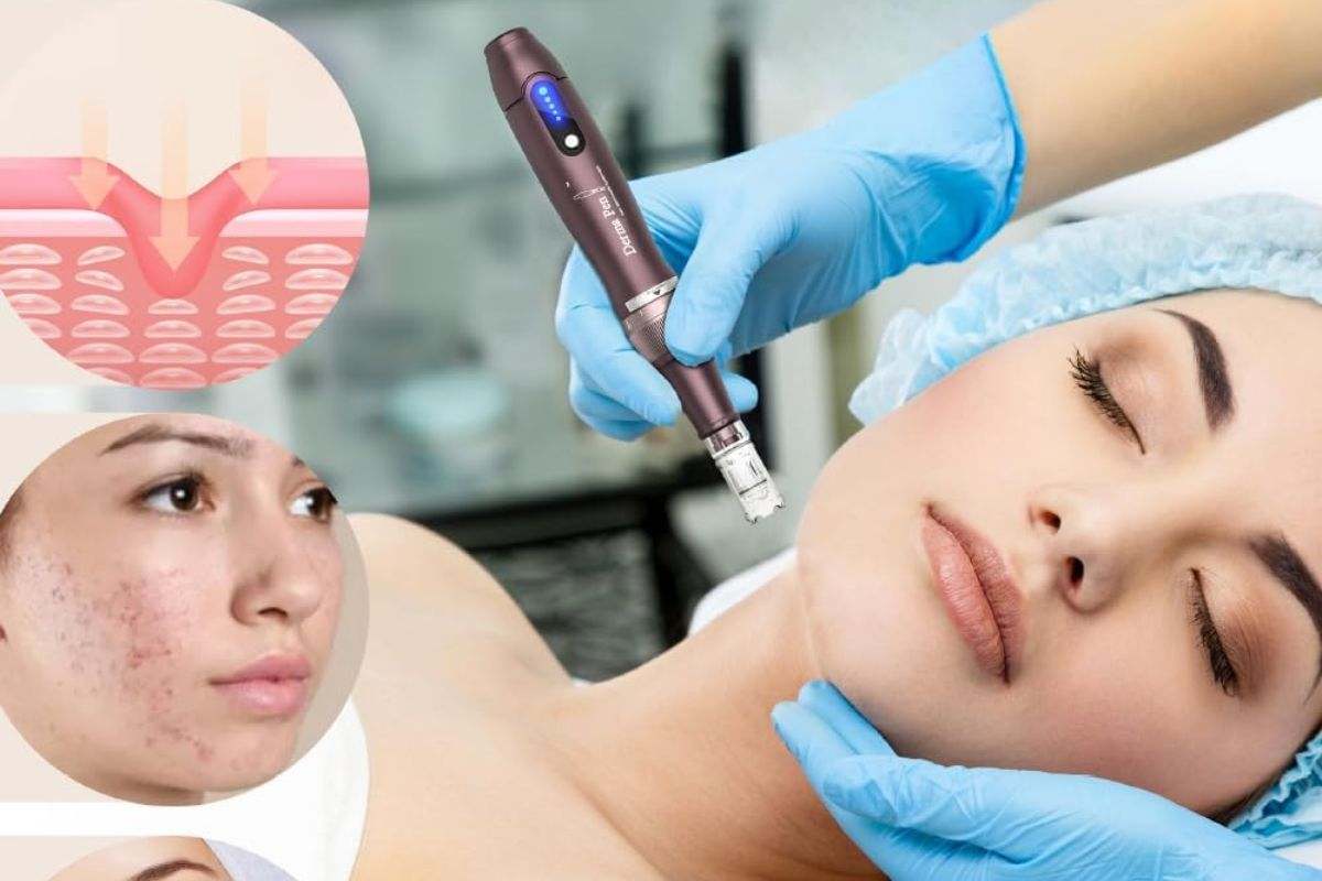 El mejor microneedling para la piel con descuento3