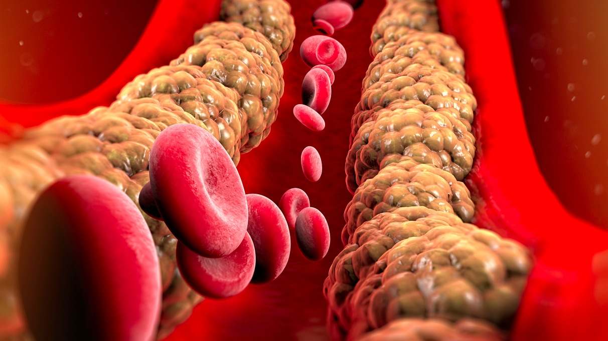 El colesterol malo es perjudicial para nuestra salud. Descubre en este artículo como bajarlo y diferenciarlo del bueno.
