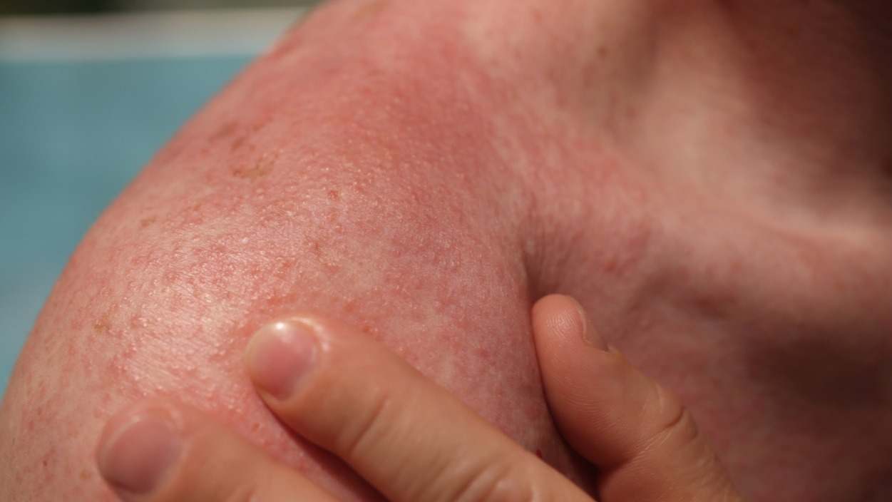 ¿Qué es la alergia al sol y cómo puede tratarse? Descubre aquí las causas más comunes y los tratamientos para aliviar los síntomas.