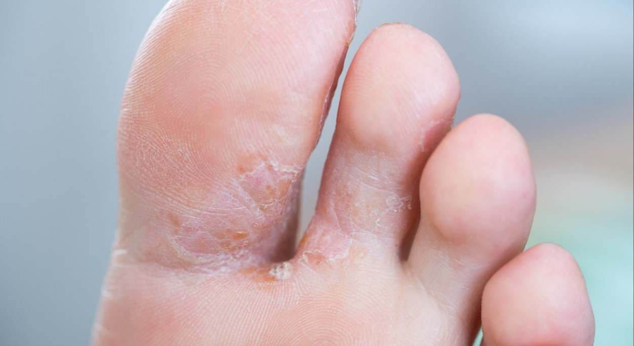 ¿Qué infecciones por hongos son más comunes en verano? Te las contamos aquí